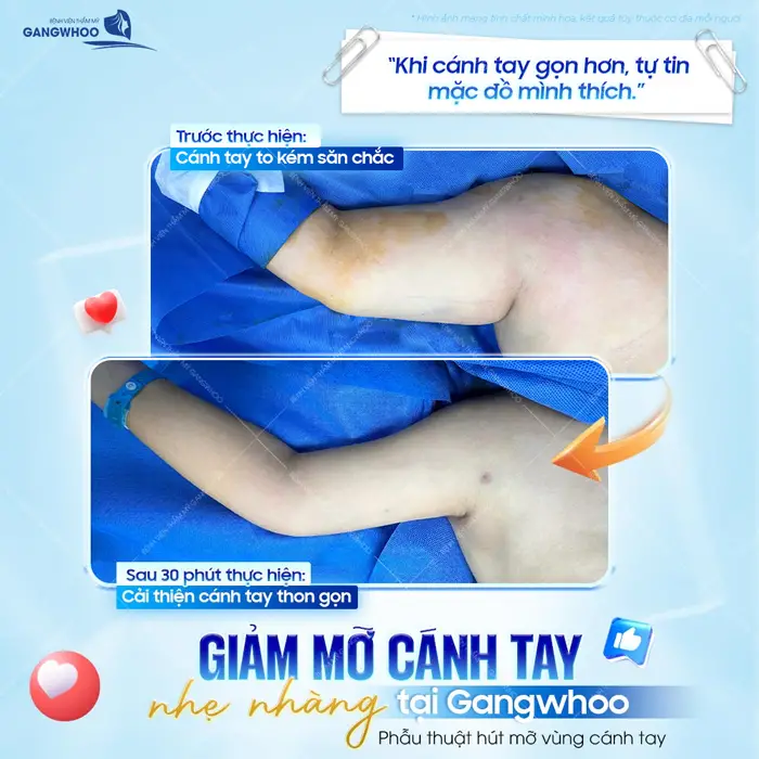 Sau 30 phút thực hiện cải thiện cánh tay thon gọn, giảm mỡ cánh tay nhẹ nhàng tại Gangwhoo 