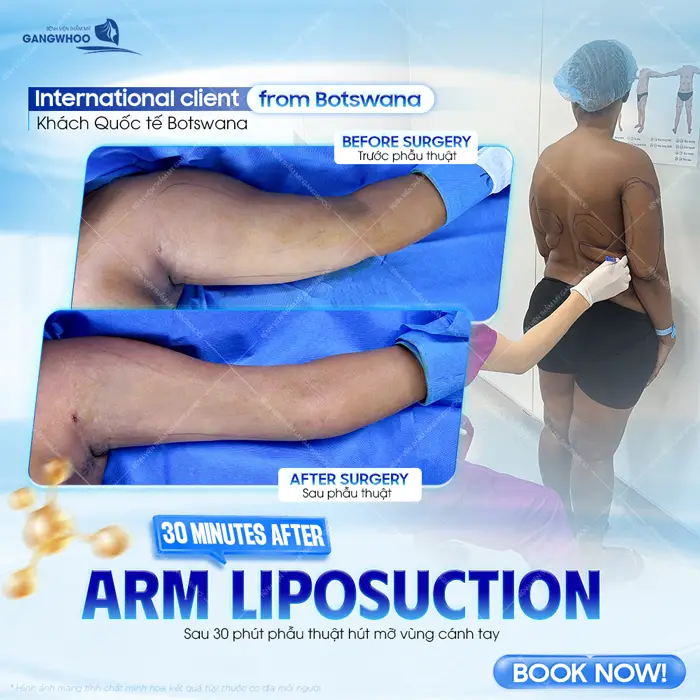 Sau 30 phút hút mỡ vùng cánh tay tự tin khoe đôi tay thon đẹp ngay sau khi thực hiện