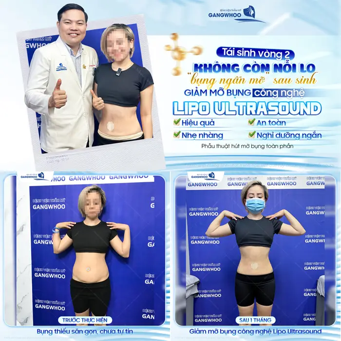 Tái sinh vòng 2 không còn nỗi lo bụng ngấn mỡ sau sinh với công nghệ giảm mỡ Lipo Ultrasound