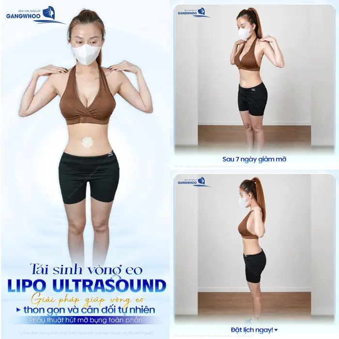 Tái sinh vòng eo Lipo Ultrasound giải pháp giúp vòng eo tự tin hơn với body đẹp thon gọn và cân đối tự nhiên