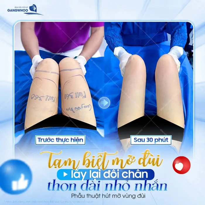 Tạm biệt mỡ đùi lấy lại đôi chân thon dài nhỏ nhắn đẹp xuất sắc ngay sau 30 phút thực hiện 
