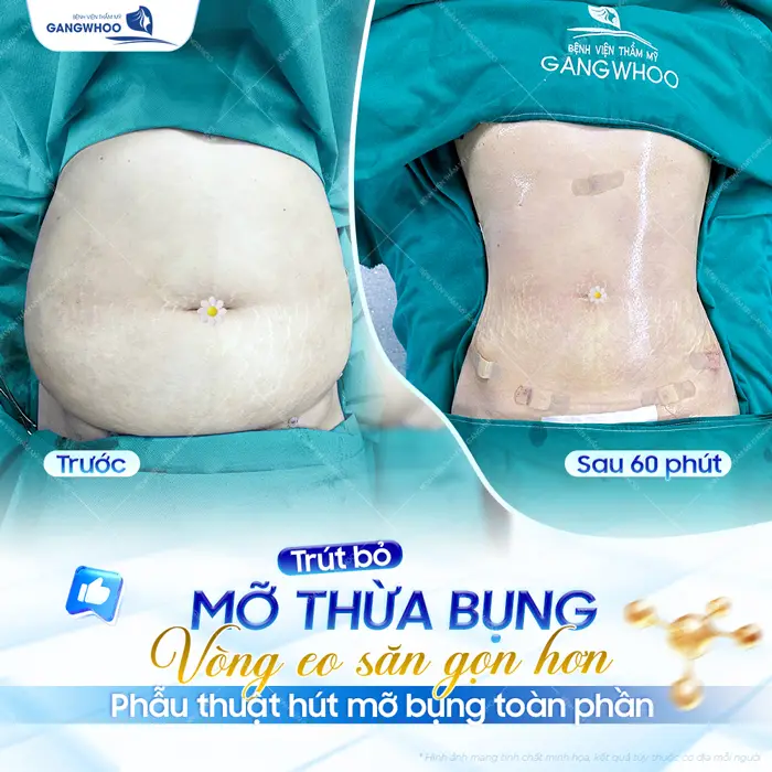 Trút bỏ mỡ thừa vùng bụng vòng eo co săn gọn chỉ sau 60 phút đã thấy kết quả khác biệt 