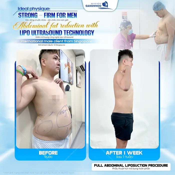 Hút Mỡ Bụng Cho Nam Giới Loại Bỏ Bụng Bia Trong 60 Phút 4 Phẫu thuật hút mỡ bụng toàn phần công nghệ Lipo Ultrasound vòng eo phẳng nuột đẹp chuẩn sắc vóc phái mạnh