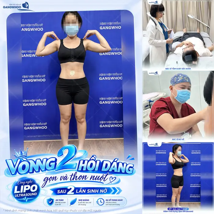 Quy trình hút mỡ bụng Chuẩn Y Khoa Diễn Ra Như Thế Nào? 7 Vòng 2 hồi dáng với quy trình chuẩn hóa trả lại đường cong cuốn hút và tôn lên sắc vóc tự tin cho cơ thể