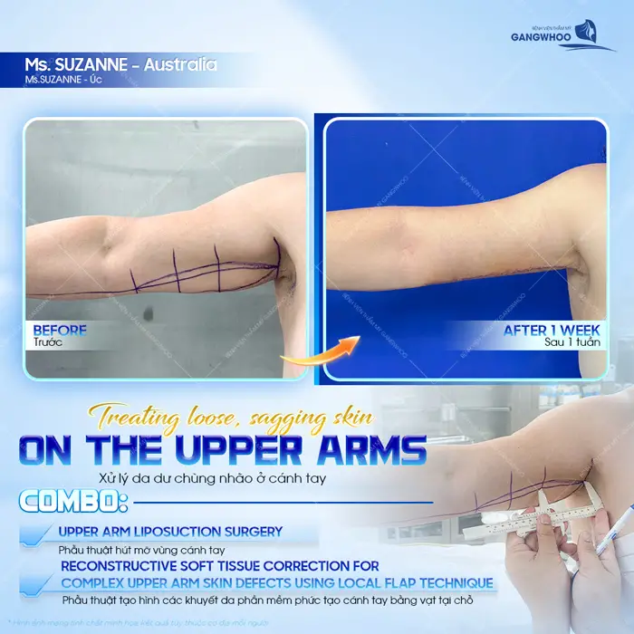 Phẫu thuật hút mỡ vùng cánh tay xử lý da dư chùng nhão hiệu quả, an toàn và không xâm lấn 