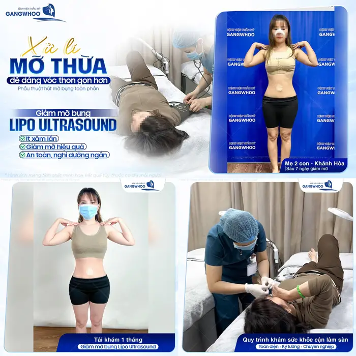 Xử lý mỡ thừa dễ dàng tự nhiên vóc dáng đẹp thon gọn với quy trình chuẩn hóa từng bước