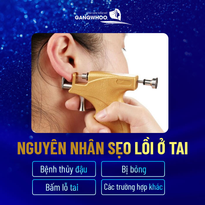 7 Cách Điều Trị Sẹo Lồi Ở Tai Khi Bấm Lỗ Tai 8 Sẹo Lồi Ở Tai