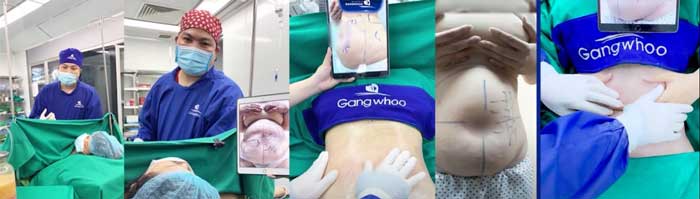 niem hanh phuc vo oa cua nguoi phu nu u40 nho hut mo cong nghe cao lipo ultrasound 3