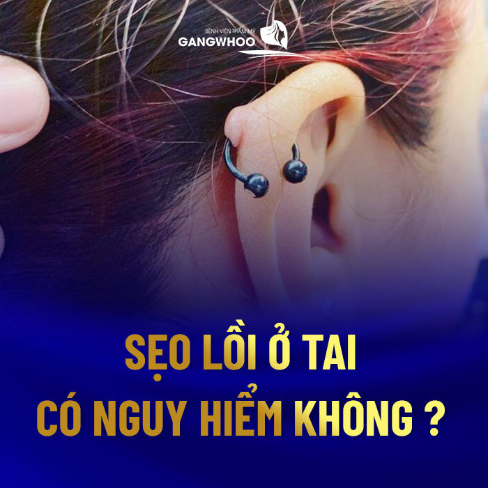 7 Cách Điều Trị Sẹo Lồi Ở Tai Khi Bấm Lỗ Tai 9 Sẹo Lồi Ở Tai