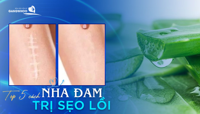 nha dam tri seo loi 1