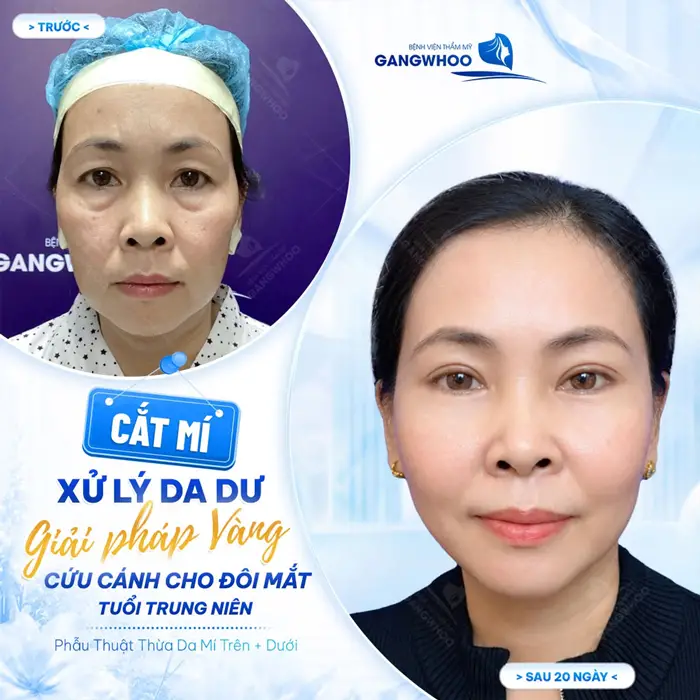Cắt mí xử lý da dư cứu cánh cho đôi mắt tuổi trung niên đẹp sắc nét và rạng ngời