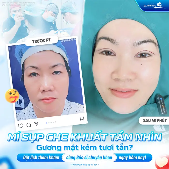 Cắt Mí Mắt Bị Sẹo Lồi: 4 Nguyên Nhân Và Cách Khắc Phục 8 Cắt mí khắc phục mí sụp ngay sau 45 phút phẫu thuật đôi mắt đã tươi tắn hơn thấy rõ