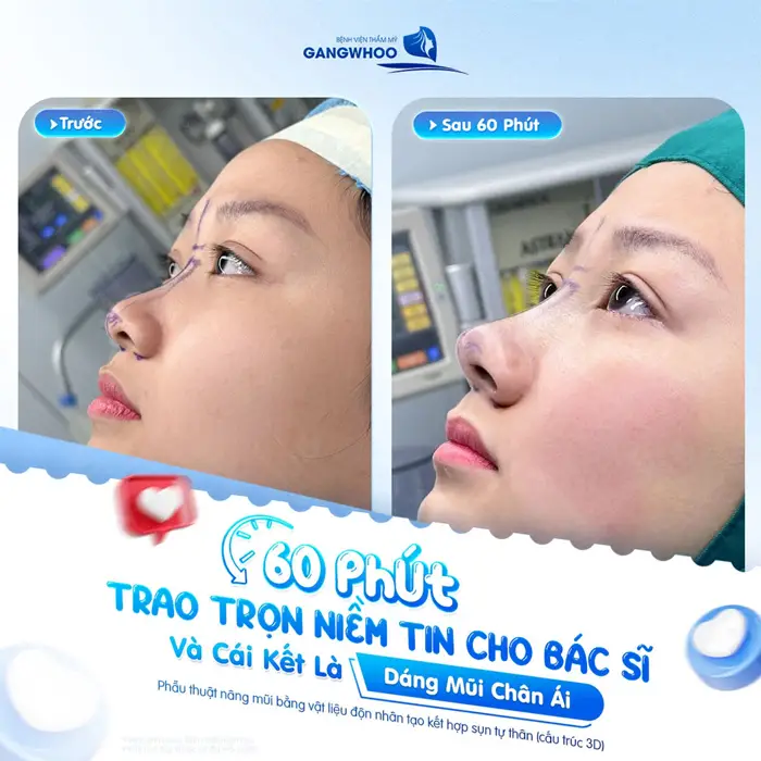 Két quả sau 60 phút trao trọn niềm tin cho bác sĩ và cái két dáng mũi cao đẹp xuất sắc