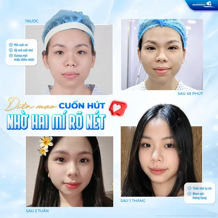 Diện mạo cuốn hút nhờ 2 mí rõ nét dau 1 tháng thần thái đã thăng hạng hơn 
