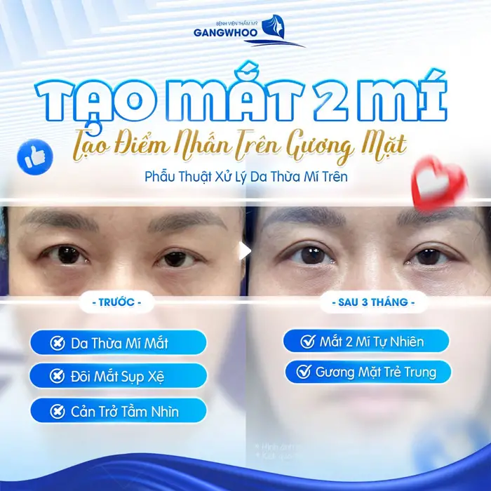 Tạo mắt 2 mí tạo điểm nhấn trên gương mặt thêm hài hòa mắt thêm rạng rỡ và đẹp bừng sáng