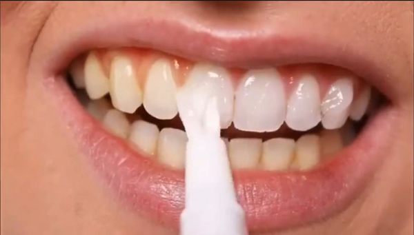 Nên sử dụng bút tẩy trắng răng tại nhà hay đến phòng nha
