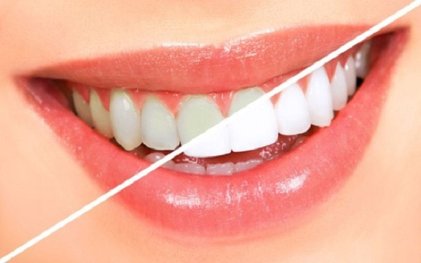 Có Nên Tẩy Trắng Răng? Nên nếu bạn muốn có hàm răng trắng sáng