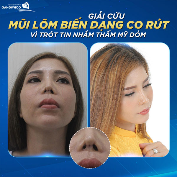 Amazing transformation after nose revision at Gangwhoo
