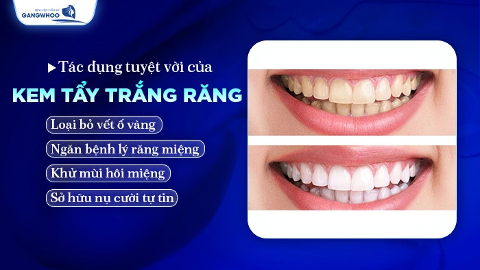Kem Tẩy Trắng Răng
