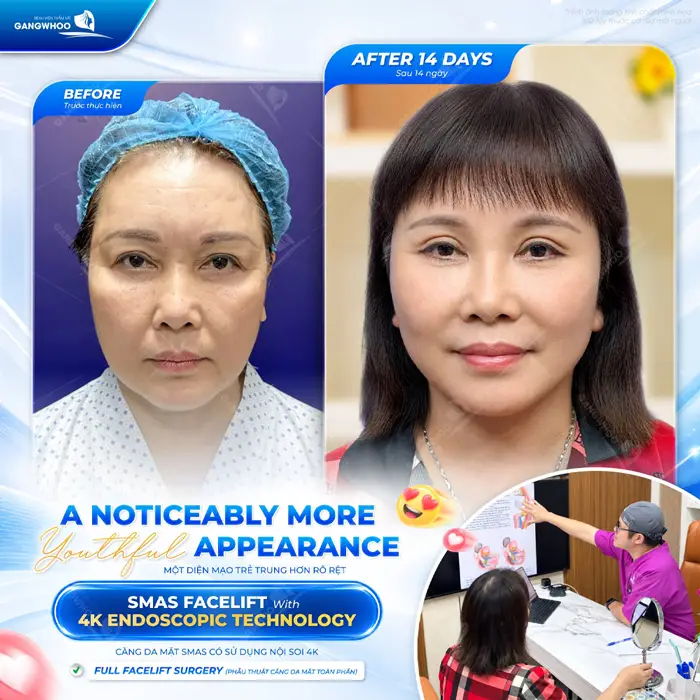 1 diện mạo trẻ trung gương mặt thêm thanh thoát và rạng rỡ hơn sau thực hiện căng da mặt Smas có sử dụng nội soi 4K
