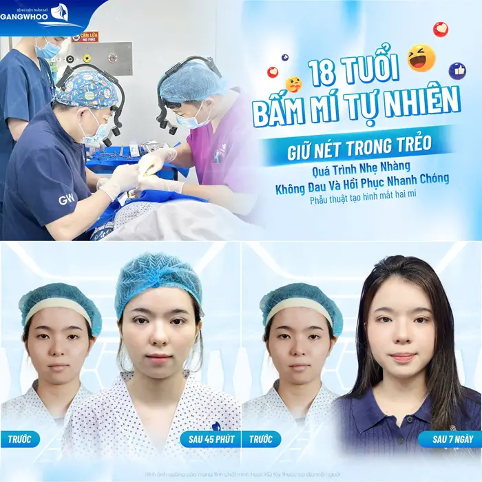 18 tuổi bấm mí tự nhiên giữ nét trong trẻo quá trình nhẹ nhàng không đau và hồi phục nhanh chóng
