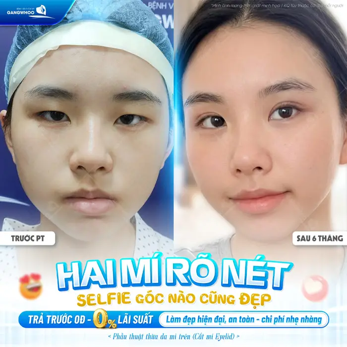 Có Nên Cắt Mí Trả Góp Không? Ưu Và Nhược Điểm Là Gì? 3 Hai mí rõ nét góc nào cũng đẹp trả trước 0% với lãi suất và chi phí nhẹ nhàng