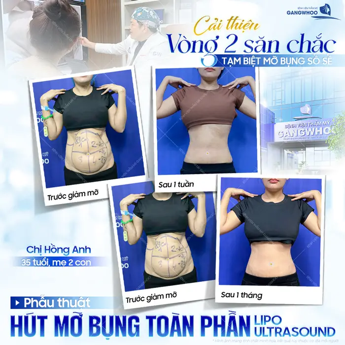 Cải thiện vòng 2 săn chắc tạm biệt mỡ bụng sồ sề mẹ bỉm 2 con tự tin lấy lại vóc dáng nuột nà