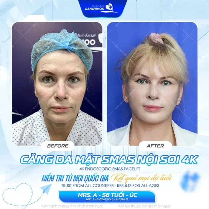 cang da mat smas noi soi 4k su thay doi day ngoan muc 3 e1775180308786