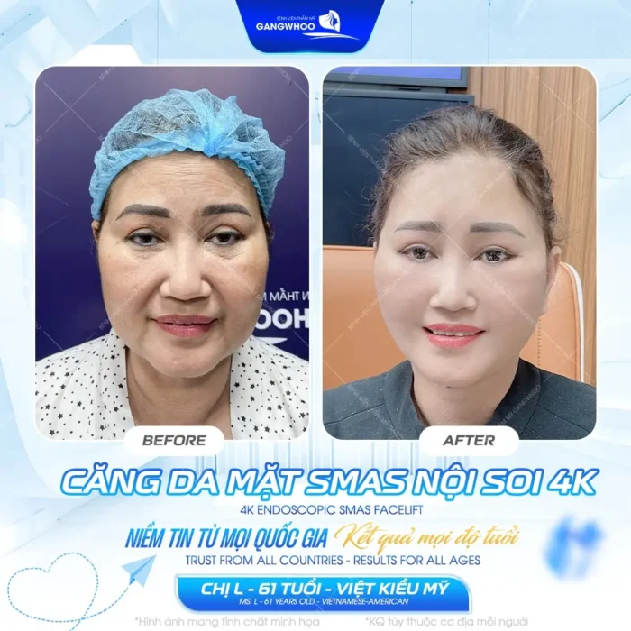 cang da mat smas noi soi 4k su thay doi day ngoan muc 4 e1792635431753