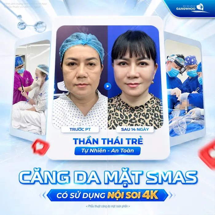 Căng da mặt Smas nội soi 4K thần thái trẻ đẹp, làn da tư nhiên, an toàn rạng rỡ tự tin khoe sắc 