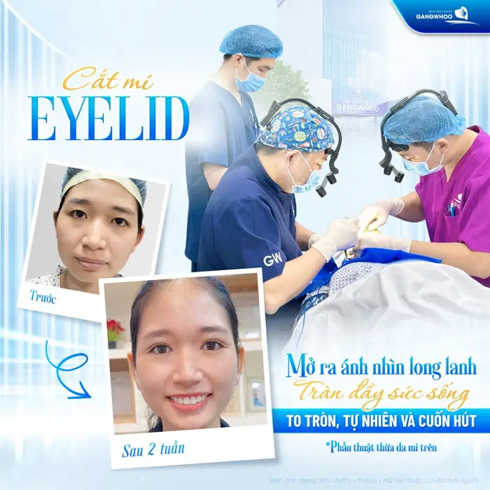 Phẫu thuật thừa da mi trên ánh nhìn long lanh đẹp căng tràn đầy sức sống