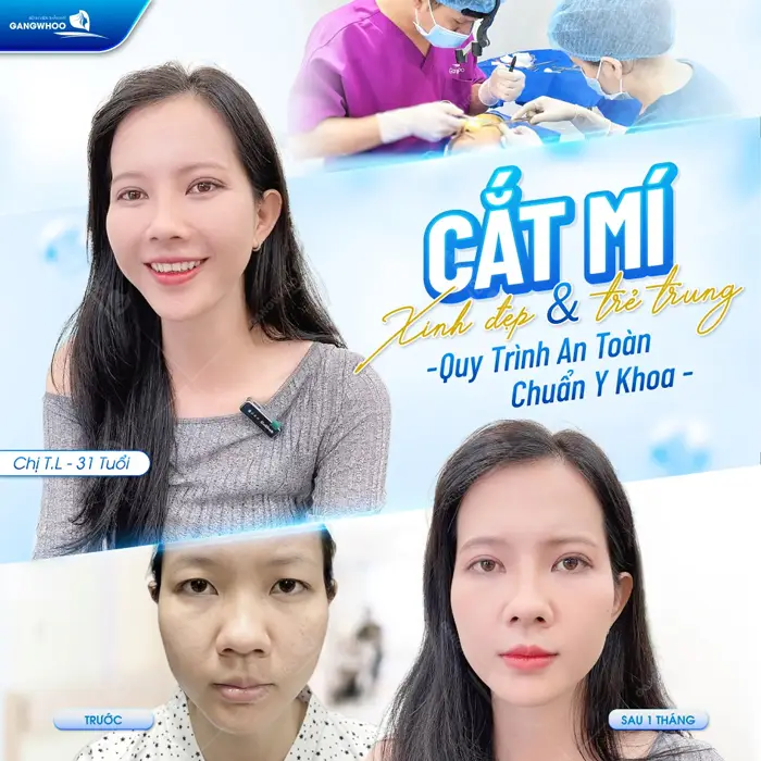 Quy trình cắt mí an toàn, chuẩn y khoa mí xinh đẹp và trẻ trung hơn