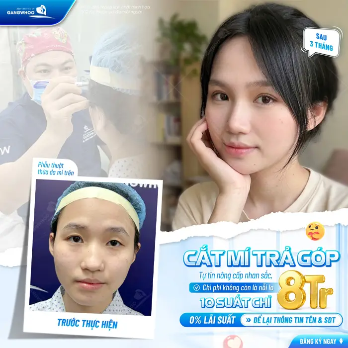 Có Nên Cắt Mí Trả Góp Không? Ưu Và Nhược Điểm Là Gì? 1 Cắt mí trả góp tự tin nâng cấp nhắn sac khong lo áp lực chi phí