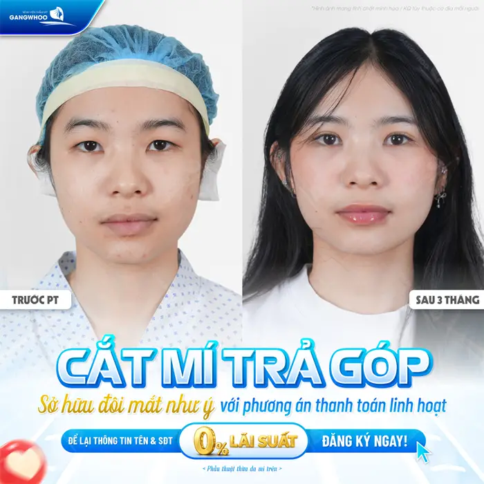 Có Nên Cắt Mí Trả Góp Không? Ưu Và Nhược Điểm Là Gì? 4 Cắt mí trả góp sở hữu đôi mắt đẹp như ý với phương phap thanh toán linh hoạt