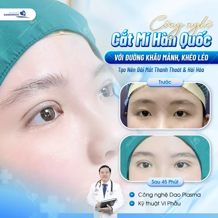 Cắt mí lựa chọn hoàn hảo cho đôi mắt đẹp thanh thoát và hài hòa theo thời gian