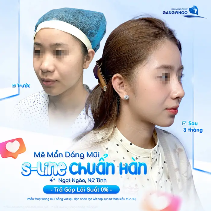Mê mẩn dáng mũi S Line đẹp chuẩn Hàn trả góp lãi suất 0% sau 3 tháng nhan sắc đã đẹp thu hút ánh nhìn