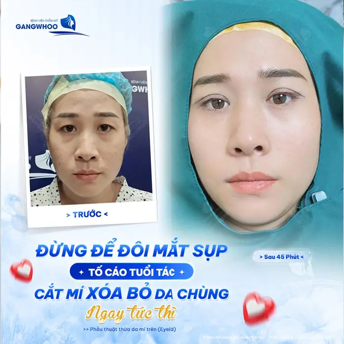 Cắt mí loại bỏ da thừa mí trên cải thiện nếp nhăn nhão chùng khôi phục lại diện mạo tự tin cho gương mặt