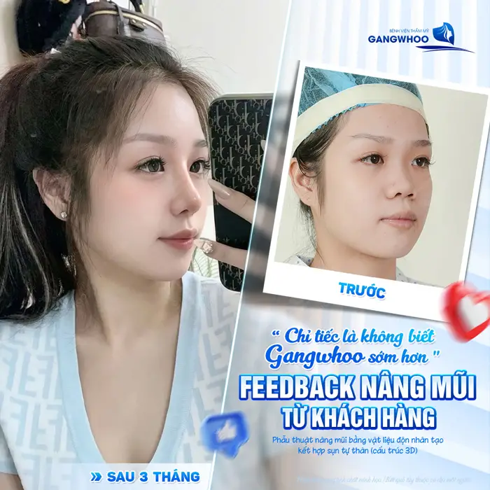 Sau 3 tháng nâng mũi từ nhan sắc đến diện mạo đều thay đổi đến kinh ngạc với sắc diện ngày càng thăng hạng và tự tin hơn 
