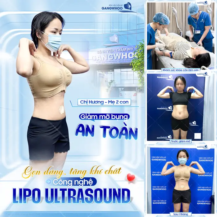 Top 5 Địa Chỉ Hút Mỡ Trả Góp Uy Tín Tại TPHCM 3 Giảm mỡ bụng an toàn gọn dáng, tăng khí chất với công nghệ Lipo Ultrasound hiện đại
