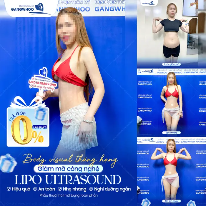 Top 5 Địa Chỉ Hút Mỡ Trả Góp Uy Tín Tại TPHCM 1 Giảm mỡ công nghệ Lipo Ultrasound hiệu quả nhanh, an toàn và nhẹ nhàng với chi phí lãi suất thấp