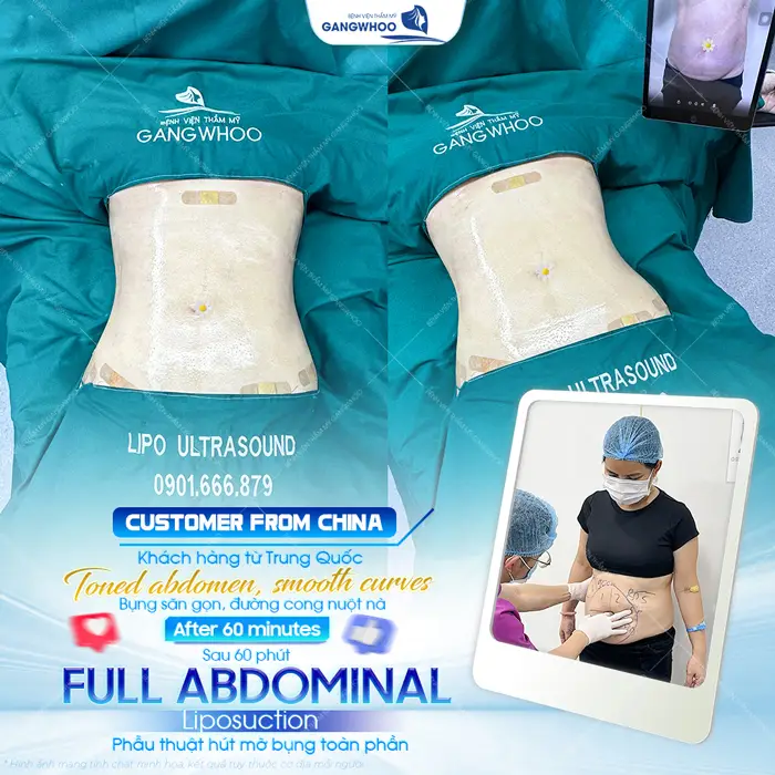 Phẫu thuật hút mỡ bụng toàn phần chỉ sau 60 phút bụng săn chắc và nuột nà cuốn hút