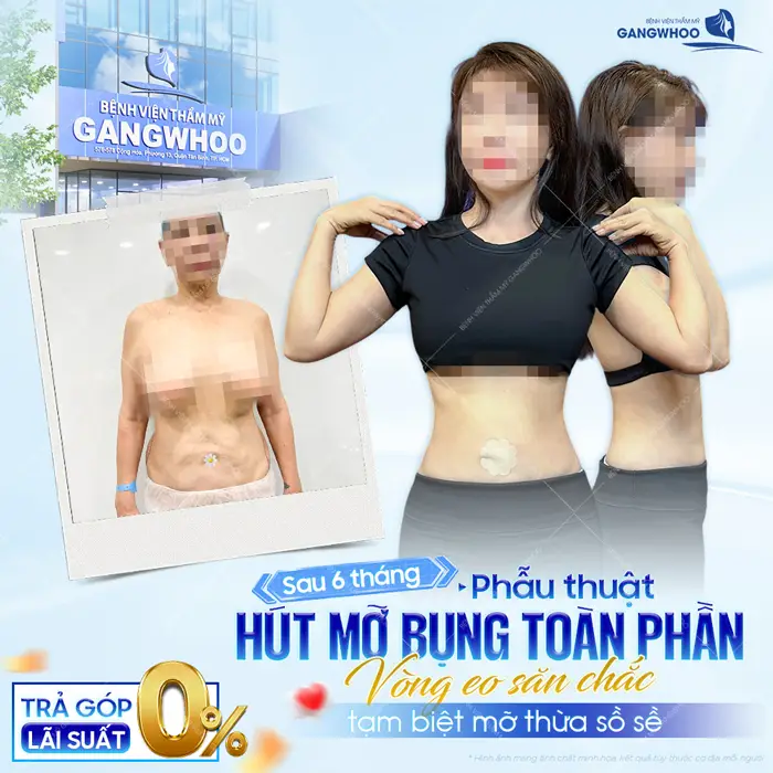 Sau 6 tháng phẫu thuật hút mỡ bụng toàn phần vòng eo săn chắc tạm biệt mỡ thừa sồ sề