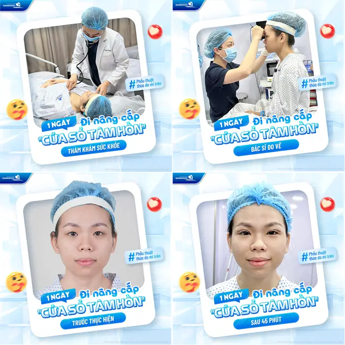 Top 3 Địa Chỉ Cắt Mí Trả Góp Giá Rẻ Tại TPHCM 18 1 ngày đi nâng cấp đôi mắt với quy trình phục vụ chuyên nghiệp, tận tình với kết quả sau thực hiện đã hoàn toàn khác biệt
