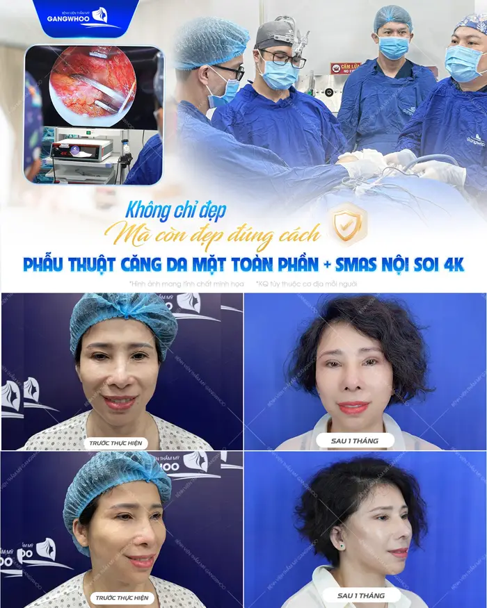 Không chỉ đẹp còn đẹp và an toàn với kết quả căng da mặt toàn phần Smas nội soi 4K