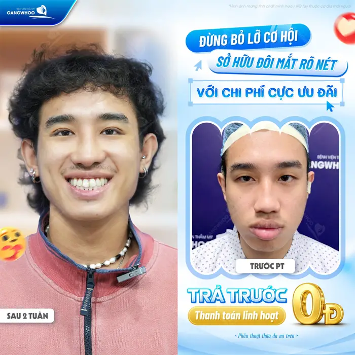 Có Nên Cắt Mí Trả Góp Không? Ưu Và Nhược Điểm Là Gì? 2 Đừng bỏ lỡ cơ hội sở hữu mắt 2 mí rõ nét với chi phú cực ưu đãi trả trước thanh toán linh hoạt
