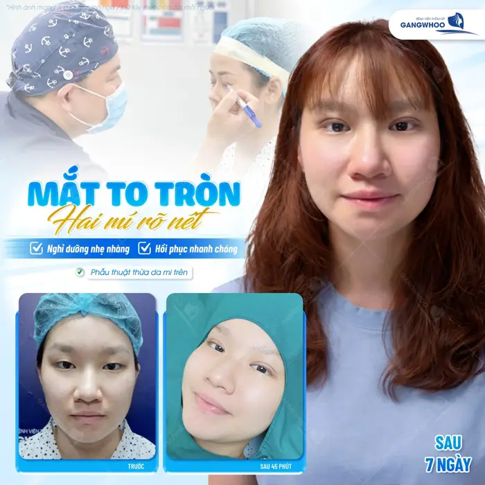 Mắt to tròn 2 mí đẹp rõ nét chỉ cần nghỉ ngưi và hồi phục nhanh chóng diện mạo đã sớm tươi tắn trở lại 