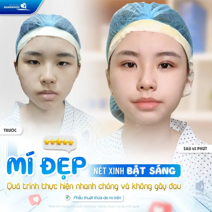 Mí đẹp nét xinh bật sáng qusa trình thực hiện nhanh chóng và không gây đau 