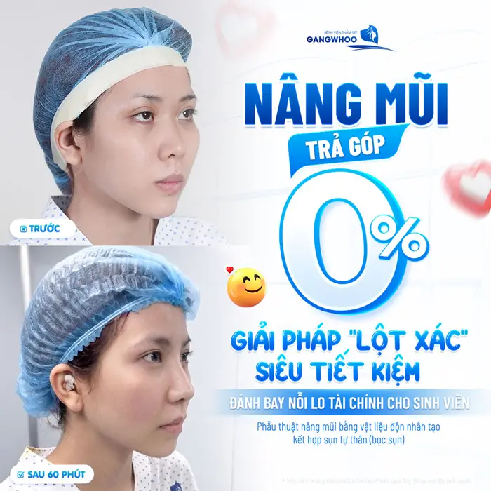 Nâng mũi trả góp giải pháp "lột xác" siêu tiết kiệm đánh bay nỗi lo tài chính cho sinh viên