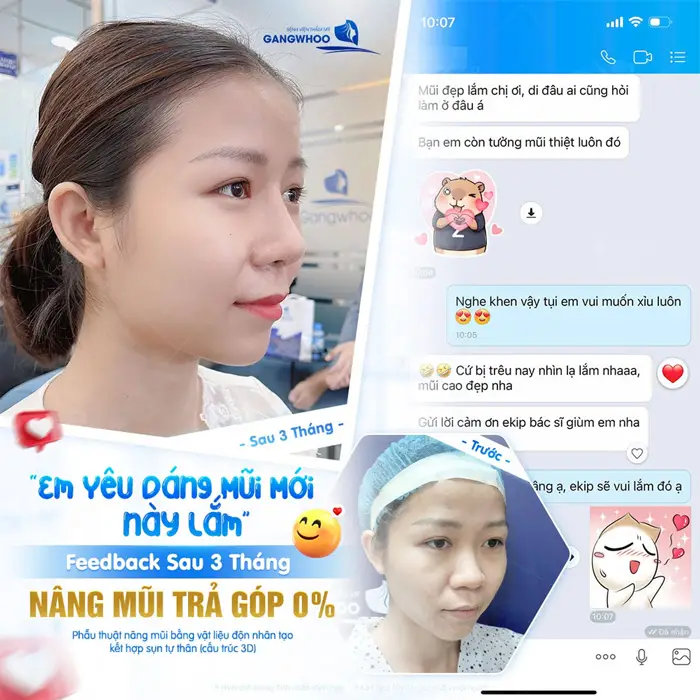 Feedback sau 3 tháng nâng mũi trả góp nhan sắc thăng hạng, diện mạo tự tin hơn thấy rõ