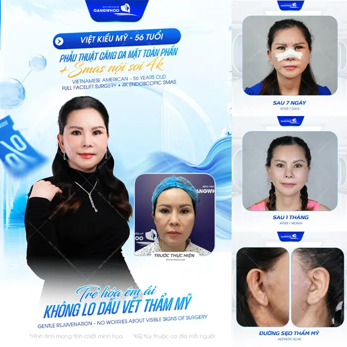 Trẻ hóa êm ái không lo dấu vết thẩm mỹ với phẫu thuật căng da mặt toàn phần Smas nội soi 4K